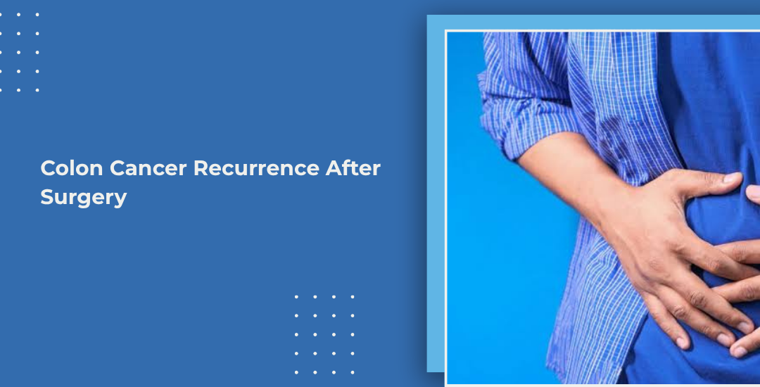 Colon Cancer Recurrence After Surgery