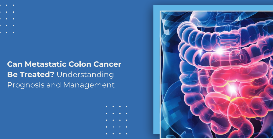 Can Metastatic Colon Cancer Be Treated? Understanding Prognosis and Management