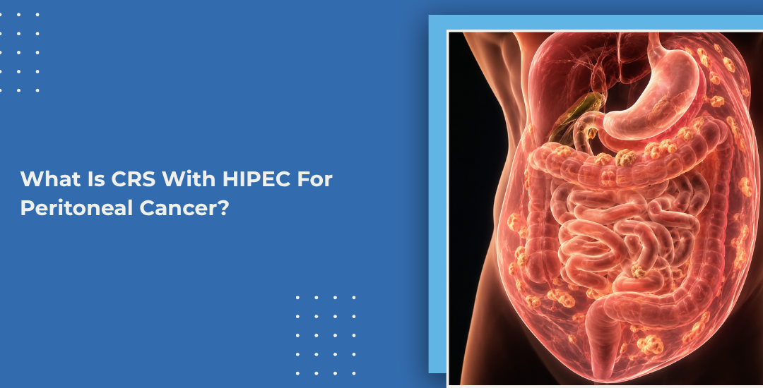 What Is CRS With HIPEC For Peritoneal Cancer